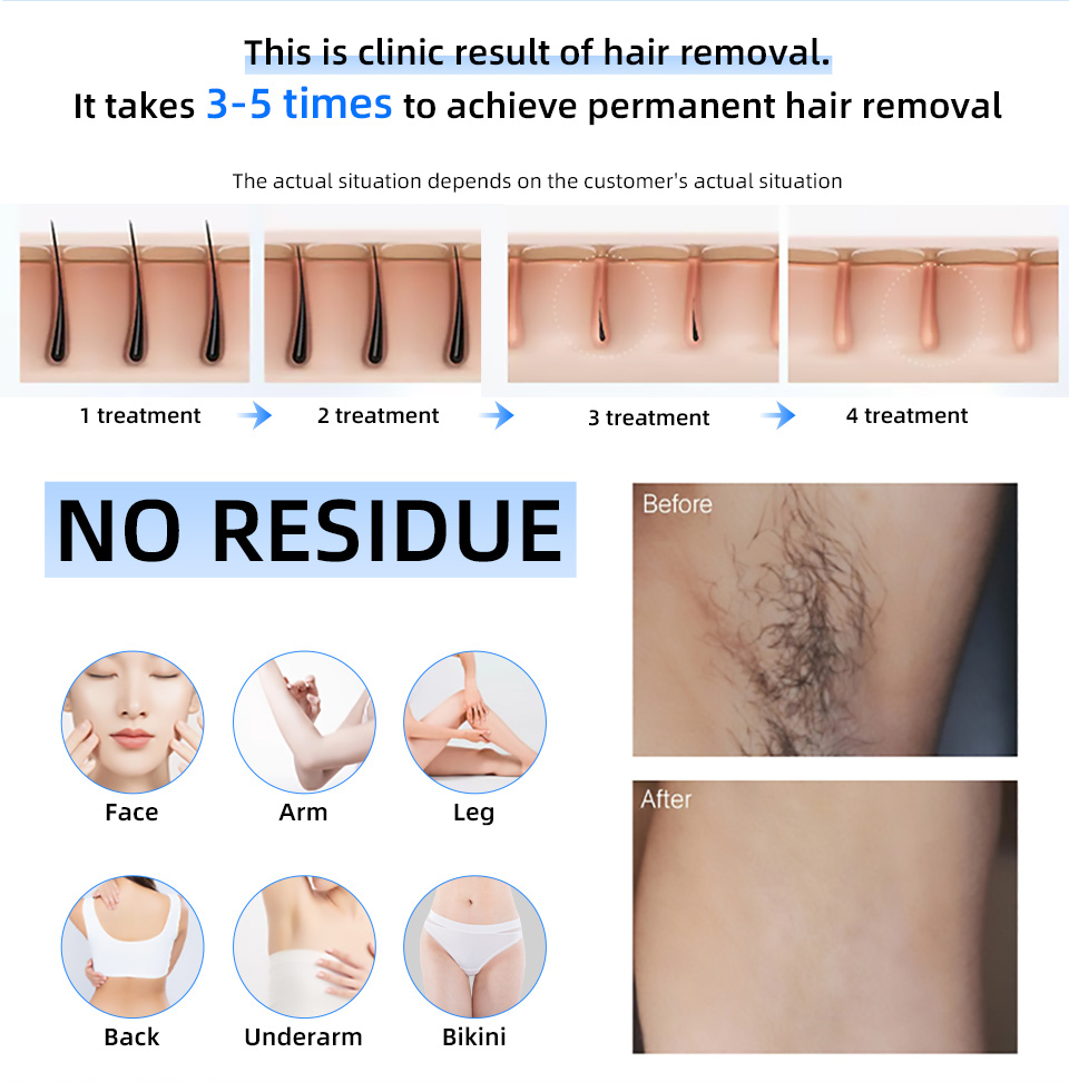 Fabrika Fiyatı 20000000   Beat - Industrial Laser Hair Removal Machine incelemesi ve fiyatı